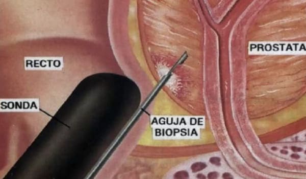 biopsia de próstata