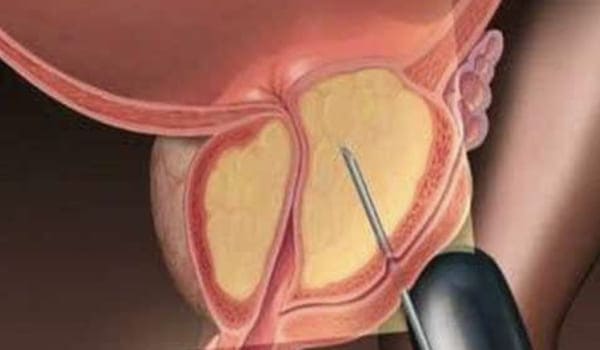 Biopsia de próstata