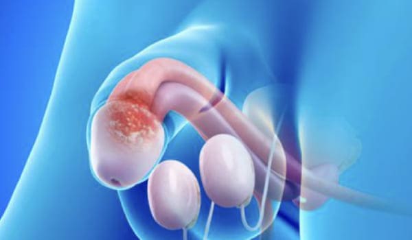 cáncer de pene