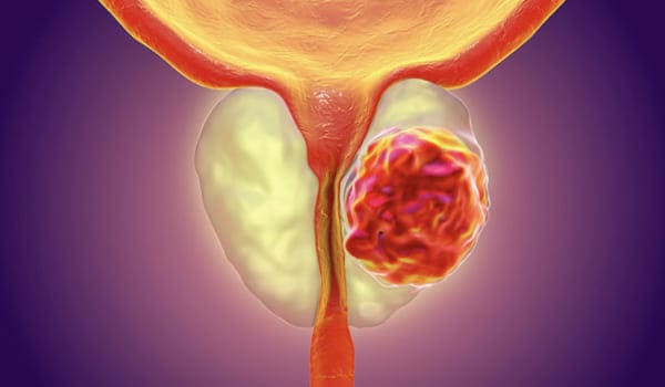 Cáncer de próstata en Bogotá