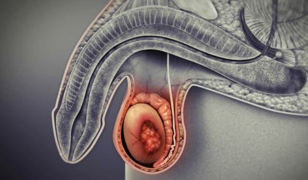 Cáncer de testículo en Bogotá