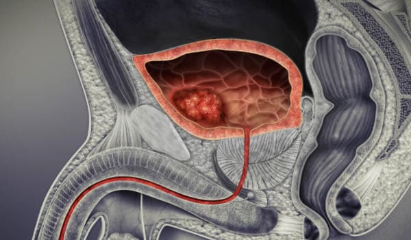 Cáncer de vejiga en Bogotá