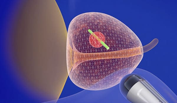 Prostatectomía Radical