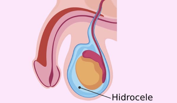 Hidrocele