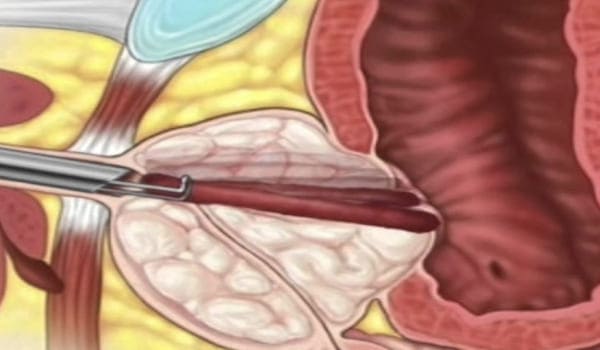 Prostatectomía Trasvesical